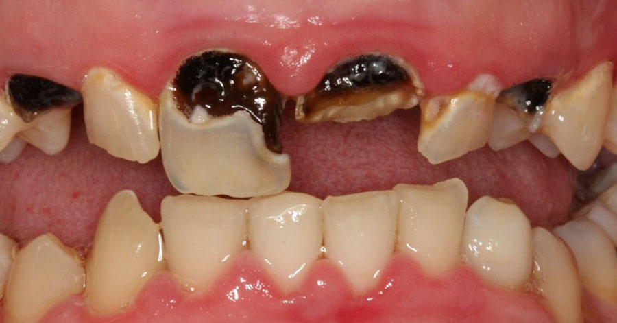 Ngậm 1 ngụm nước này 2 phút trước khi đi ngủ, không còn lo sợ sâu răng hay nhiệt miệng nữa