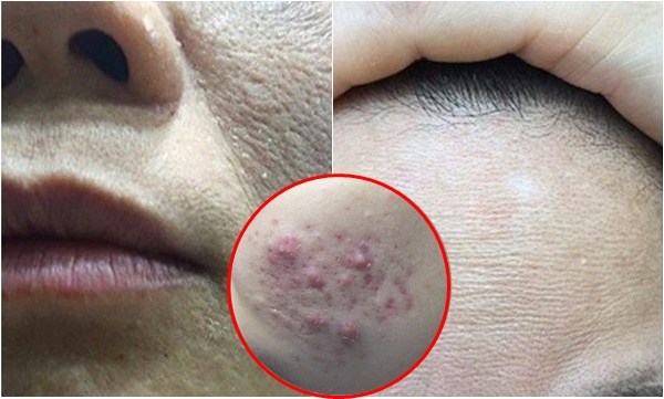 Sốc với 6 thói quen 100&permil; chị em đều làm mỗi ngày khiến da mọc đầy mụn lại sạm màu, cần bỏ ngay kẻo hối không kịp