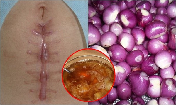 Bỏng bô, muỗi đốt hay nặn mụn để lại sẹo cũng bị “là phẳng” trong 1 tuần chỉ bằng 1 củ hành tím