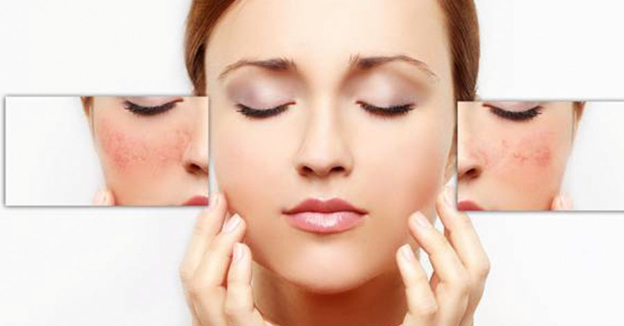 5 bước sau sẽ giúp bạn "tạm biệt" mụn trứng cá cũng như làn da bóng nhờn, trả lại làn da rạng rỡ cho bạn trong mùa hè.