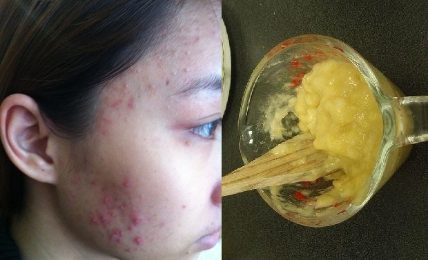 Dùng vỏ chuối theo cách này, mụn trứng cá khắp mặt cũng hết sạch chỉ sau 7 ngày