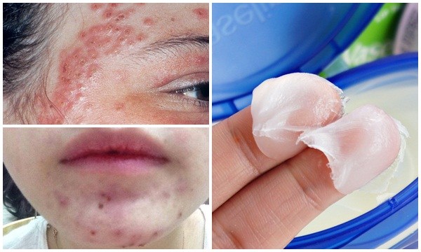 Cứ tưởng Vaseline hoàn toàn vô hại nhưng thoa theo cách này thì đừng hỏi tại sao mụn nhọt, lở loét khắp mặt