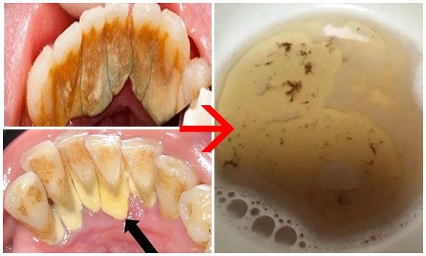 4 cách khiến cao răng cứng như đá cũng bong ra từng mảng, hôi miệng thâm niên sẽ thơm tho ngay tức khắc