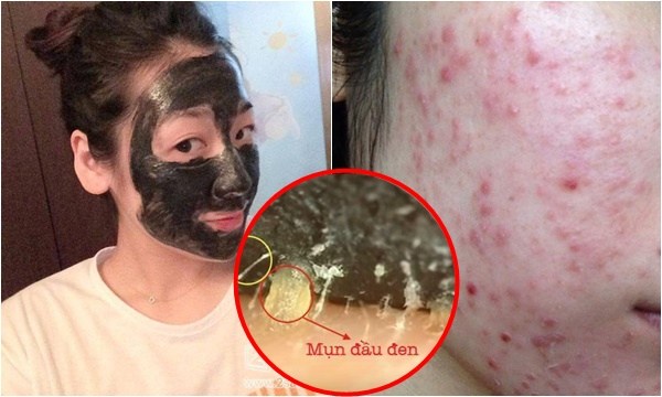 Hàng triệu cô nàng cứ lột mụn mỗi ngày mà không biết điều này đang “giết chết” làn da của mình