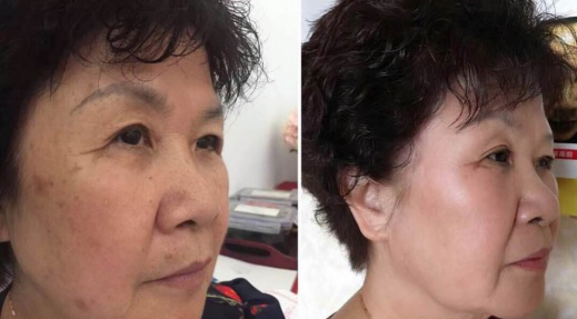 1001 cách không chữa khỏi nám da nhưng với duy nhất “mẹo hay” này đủ khiến hàng ngàn chị em “đổ gục”