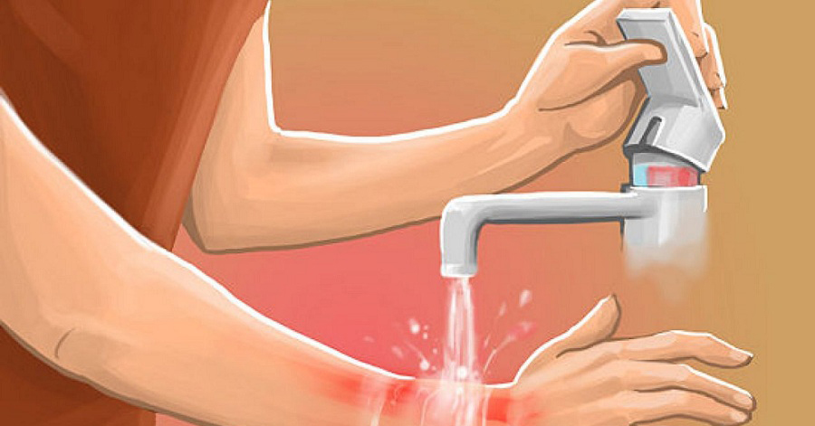 Nếu bị bỏng do nước sôi hay dầu mỡ, hãy làm ngay điều này để không bị để lại sẹo
