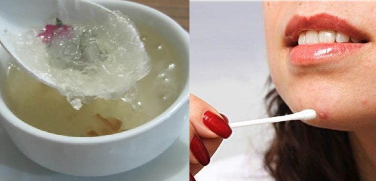 Mặt đầy mụn cũng sạch không còn 1 nốt sau vài lần thoa thứ này lên, gái hay trai đều dùng được hết