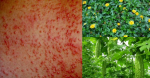 Mẹo dân gian trị rôm sẩy ở người lớn bằng các bài thuốc tự nhiên