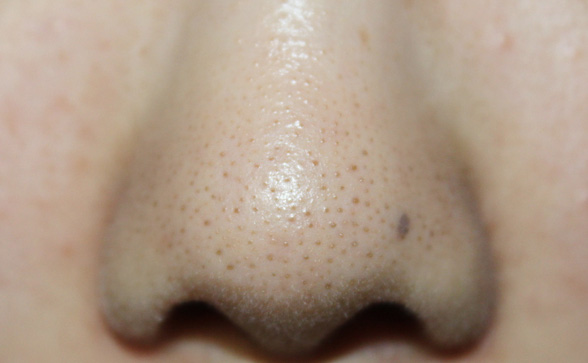 Đây là cách rẻ tiền nhất mà tôi dùng để “hạ gục” mụn đầu đen, bạn cũng thử đi