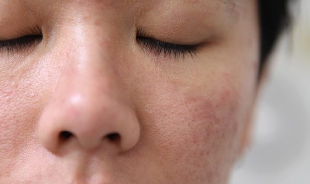 Lỗ chân lông to se nhỏ mãi mãi sau 3 ngày với phương pháp này