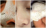Lột mụn làm gì cho to lỗ chân lông, lấy kem đánh răng thoa lên mũi thế này đi, 15 phút sau lột ra cả trăm nhân mụn đầu đen đấy