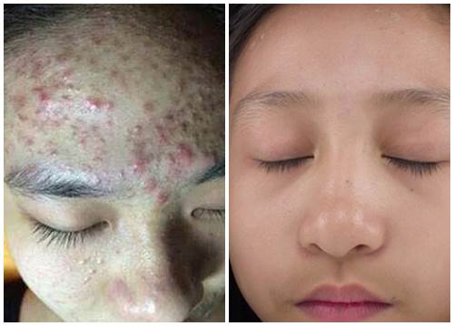 Da trắng bật 2 tone, sạch mụn, ngực tăng size đến ngỡ ngàng chỉ nhờ uống nước đậu đen