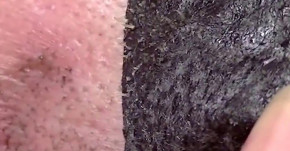 Không cần nặn đau đớn, thoa miếng lột này mụn đầu đen sẽ "dứt áo ra đi"