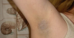 Massage với nước soda, vùng da dưới cánh tay thâm sạm trở nên trắng mịn bất ngờ