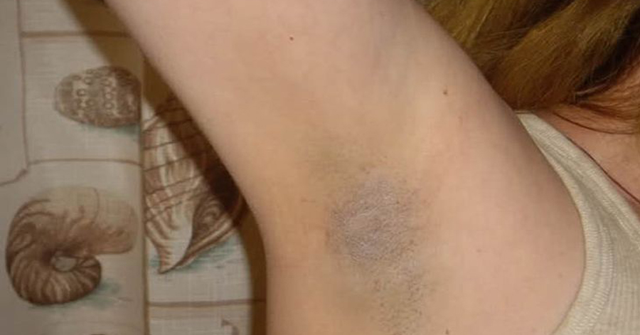 Massage với nước soda, vùng da dưới cánh tay thâm sạm trở nên trắng mịn bất ngờ