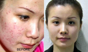 Da hết sạch mụn sau 3 ngày, trắng bóc trở lại chỉ bằng 1 lon bia của bố