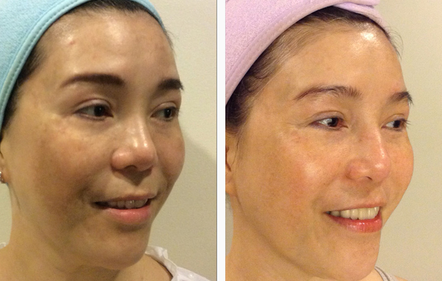 HẾT NÁM DA - Món quà vô giá từ xứ sở Hoa Anh Đào biết “chìu chuộng” vẻ đẹp phụ nữ