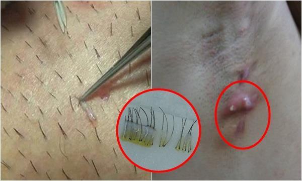 5 hậu quả kinh khủng khiếp của việc nhổ lông nách bằng nhíp và bí kíp giúp lông tự rụng không còn 1 cọng, đọc ngay kẻo tiếc