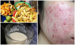 Da bị mụn “đừng dại” mà ăn những thực phẩm này kẻo “mặt nở đầy hoa” lại vô cùng khó chữa