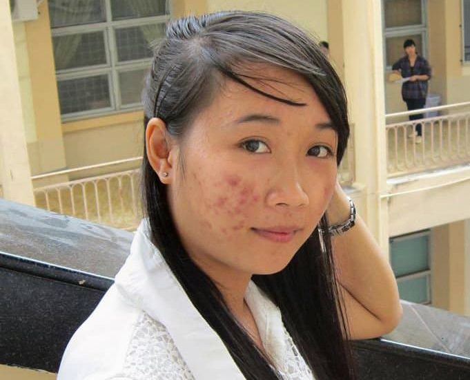 Phát hiện thêm một loại thần dược trị thâm mụn, loại bỏ dầu nhờn, se khít lỗ chân lông, dưỡng da căng mướt