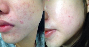 Mụn chi chít bao nhiêu hay gàu cả mảng cũng trị sạch nhờ 30 ngày dùng vỏ bưởi tươi theo cách này