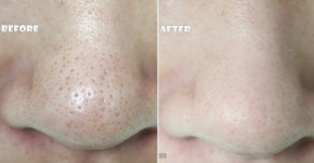 Nếu lỗ chân lông không chịu thu nhỏ hãy sử dụng lòng trắng trứng nhé!