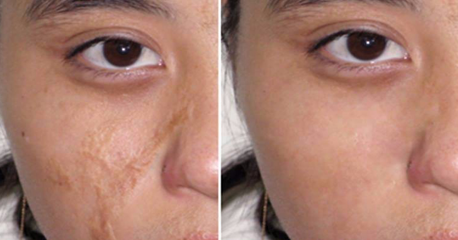 Bôi thứ này lên 30 phút mỗi ngày, sẹo lâu năm cũng từ từ mờ cho đến hết