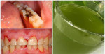 Dùng loại nước này súc miệng, trị khỏi đau nhức, ê buốt do sâu răng