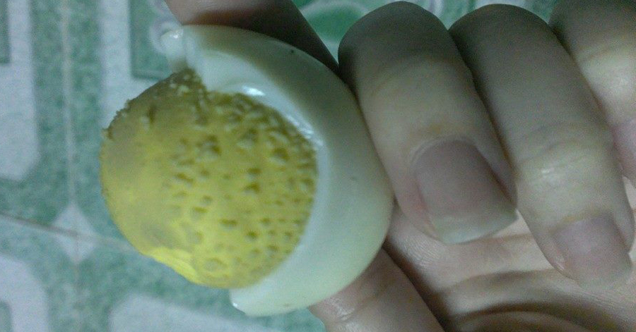 Cứ truyền nhau lăn trứng luộc lên mũi để trị mụn đầu đen, chị em không ngờ hậu quả lại nghiêm trọng đến vậy