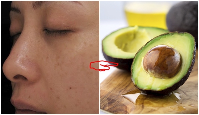 Tàn nhang nhiều đến mấy cũng mất sạch với 6 nguyên liệu đơn giản này