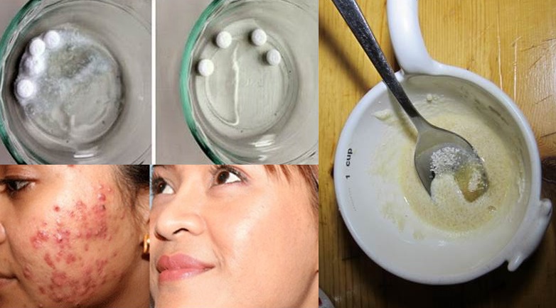 Dùng aspirin theo cách này, diệt cả trăm mụn trứng cá trắng xóa trên mặt không cần nặn đau đớn
