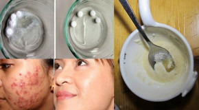 Dùng aspirin theo cách này, diệt cả trăm mụn trứng cá trắng xóa trên mặt không cần nặn đau đớn