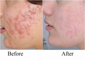 Hòa thứ bột trắng này với nước rồi bôi lên mặt, da hết mụn trứng cá, mờ sẹo thâm chỉ sau 5 phút mỗi ngày