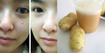 Người bị nám lâu năm mà bỏ qua bí quyết dùng chanh và khoai tây theo cách này thì phí cả đời