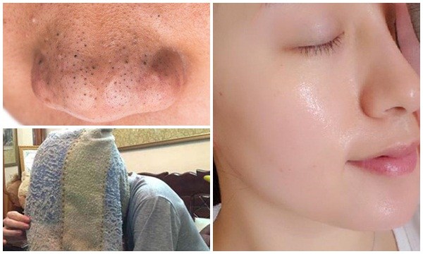 Học 4 bước dưỡng da này từ gái Hàn, cả đời không lo mụn đầu đen xuất hiện, da dẻ lúc nào cũng căng bóc như gái 20