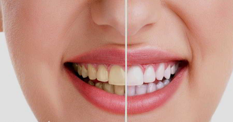 Ngậm ngụm nước này 2 phút trước khi ngủ, cao răng, vàng răng, hôi miệng kinh niên chẳng còn nữa