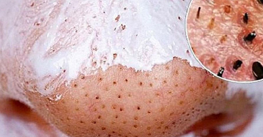 Bôi 1 giọt kem tẩy trang lên mũi 2 phút, mụn đầu đen tự chui lên không cần nặn