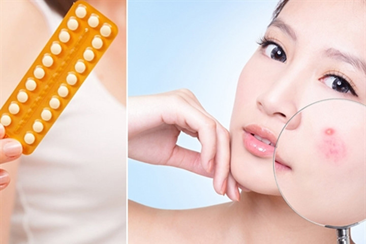 Uống thuốc tránh thai để trị mụn liệu có phải là biện pháp thông minh?