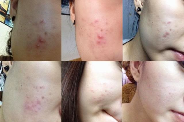 Da căng mịn, mụn ẩn cũng sạch boong không còn 1 cái chỉ nhờ vài viên aspirin nghiền nhuyễn