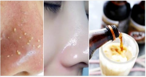 Da lên 2 tông, sạch mụn chỉ với nửa cốc đồ uống này mỗi ngày