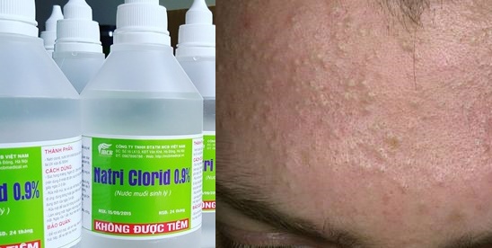 Chỉ sau 14 ngày da sạch mụn bạn không ngờ tới