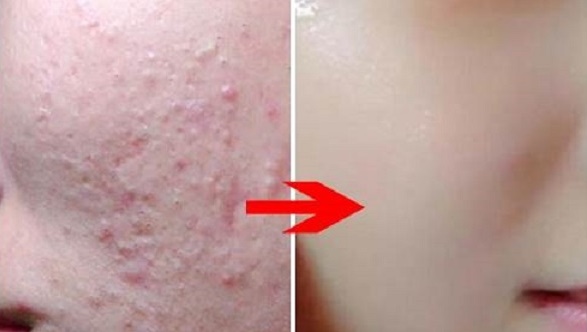Tuyệt chiêu làm đẹp "siêu phàm" của chị em là đây: Đun đậu đen mà thêm thứ này thì da sạm đen, nhiều mụn cỡ nào cũng trở nên trắng mịn