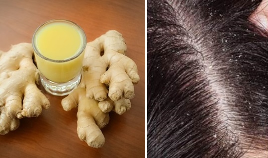 Gàu trắng cả đầu, tóc rụng như là mùa thu cũng được trị khỏi dứt điểm, gàu 1 đi không trở chỉ với cách đơn giản này