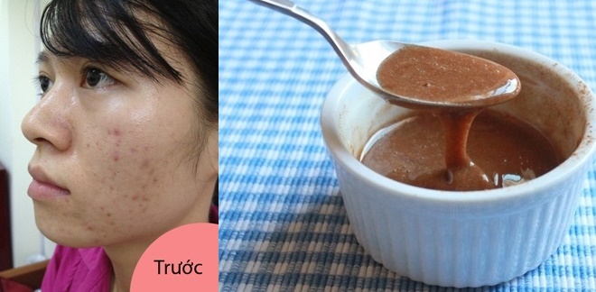 Trời ơi, đừng mất tiền triệu đi spa, em chỉ trộn chanh tươi với 3 thứ này mà mụn và sẹo thâm đã tan biến sau 3 ngày