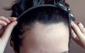 Đẩy lui mụn trán chỉ nhờ... mũ, vỏ gối, dầu gội