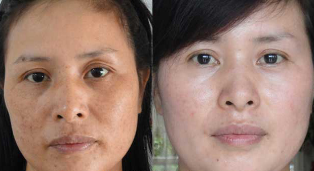 Vì sao bộ sản phẩm trị nám cao cấp Sakura tạo được “bước ngoặt” trong trị nám và chị em một mực hài lòng sử dụng?