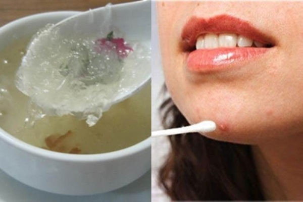 Mặt đầy mụn, thâm mụn cũng sạch không còn 1 nốt sau vài lần thoa thứ này lên, gái hay trai đều dùng được hết