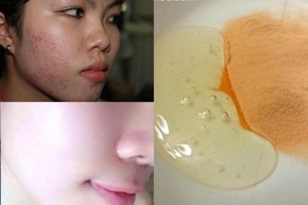 Thoa 2 viên C vào mỗi tối, mụn chi chít đến mấy cũng hết, da trắng mịn như em bé