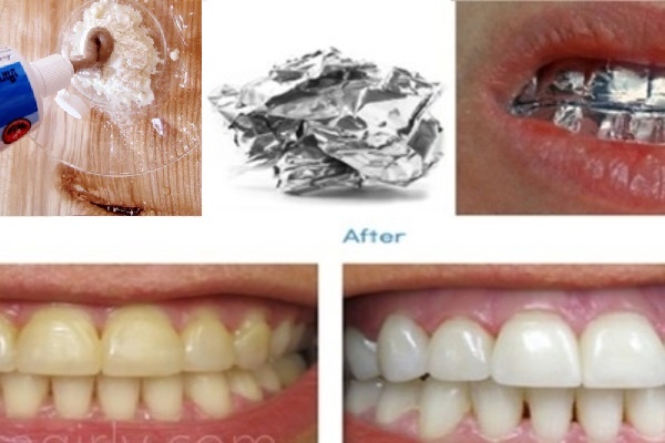 Bôi baking soda lên giấy bạc rồi bọc quanh răng, bạn sẽ bất ngờ về kết quả sau 1 lần dùng