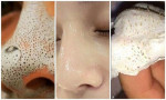 Bí kíp trị tận gốc mụn đầu đen khiến hàng tỷ người muốn làm theo ngay tức khắc